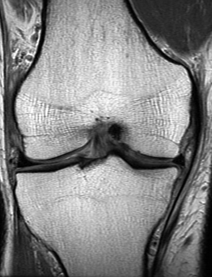 Figure 3 for case Unstable displaced medial meniscus tear( RID2772 ) with reactive tibial edema